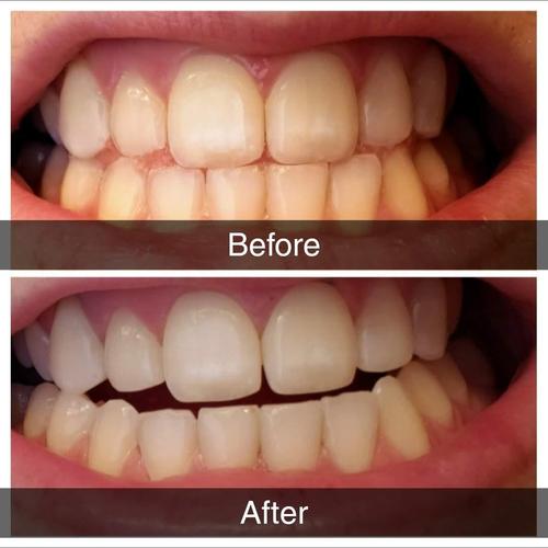 Activated Charcoal Teeth Whitening Powder photo review