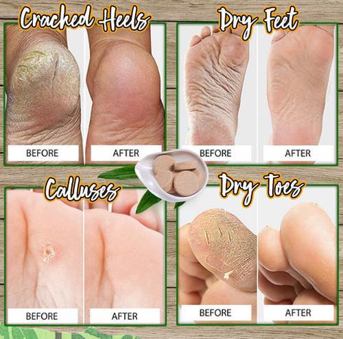 Anti-fungal Peeling Foot Soak