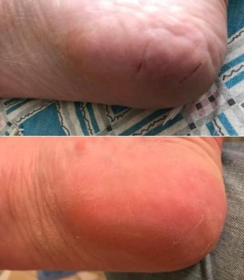 Anti-fungal Peeling Foot Soak photo review