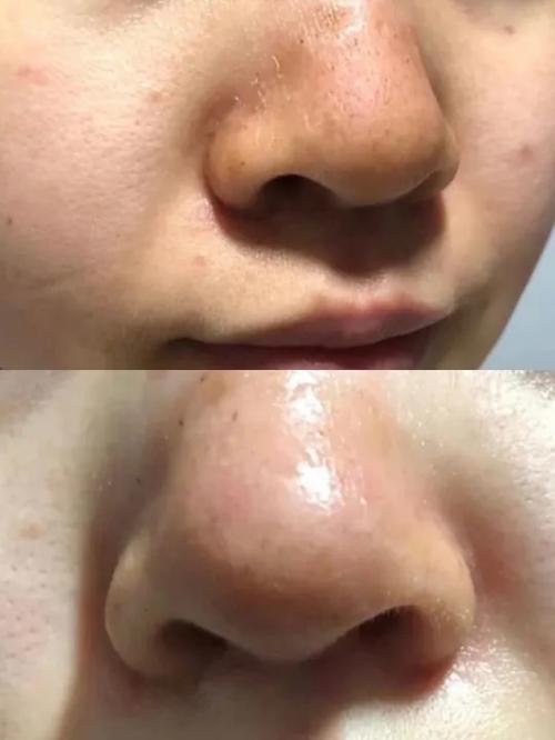 Blackhead Treatment Patch Deep Cleansing Exfoliating photo review