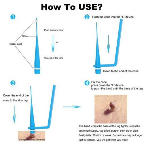 Skin Tag Removal Device, Meat Mole Removal, Corn Removal