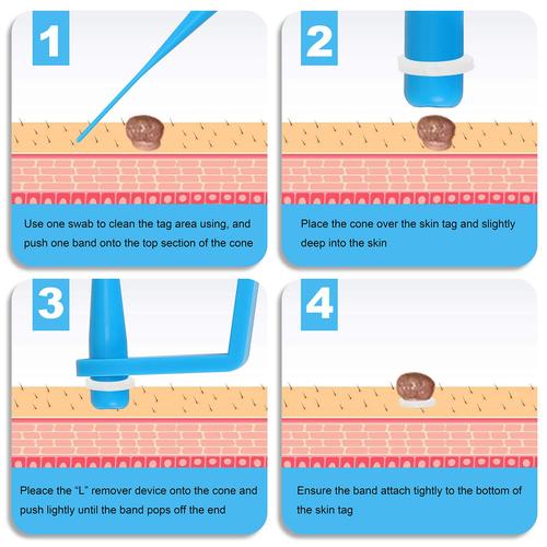 Skin Tag Removal Device, Meat Mole Removal, Corn Removal