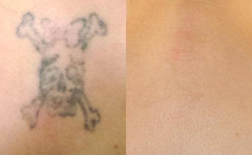 TatOFF 4 Weeks Tattoo Removal Cream photo review